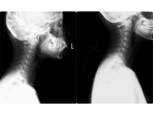 頸椎側面 (1)